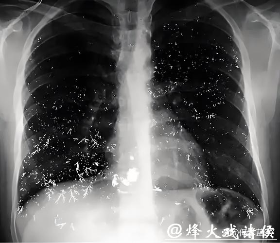 破羽绒服连穿四周,福州一男子确诊“羽绒肺”!医生提醒:严重或致呼吸衰竭! 破羽绒服连穿四周,福州一男子确诊“羽绒肺”!医生提醒:严重或致呼吸衰竭!